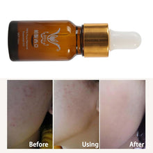 10ml Essence full-body whitening chicken skin repair essential oils remove dead skin goose bumps pimples folliculitis J4U66