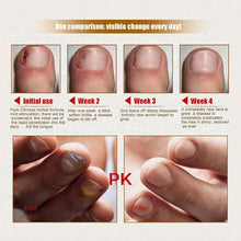 health skin care herbal nail repair treatment essential oil onychomycosis remover serum beauty disinfect J4U66