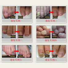 Fungal Nail Treatment Essence Nail and Foot Whitening Toe Nail Fungus Removal Feet Care Nail J4U66
