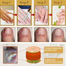 Fungal Nail Treatment Essence Nail and Foot Whitening Toe Nail Fungus Removal Feet Care Nail J4U66