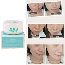 Powerful whitening Freckle cream Remove melasma Acne Spots pigment Melanin face care cream L4 J4U66